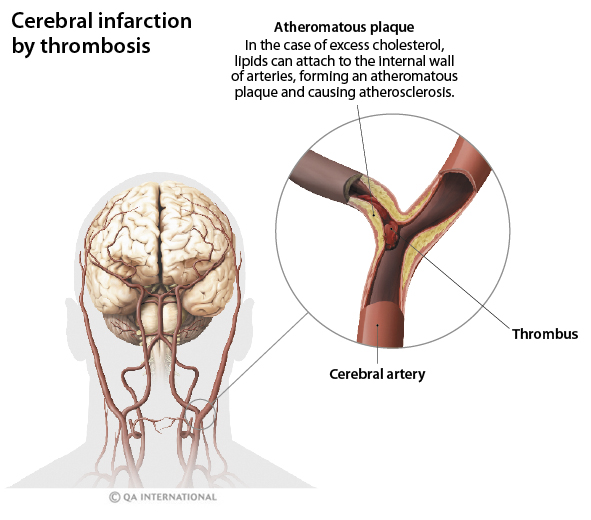 Cerebral infarction