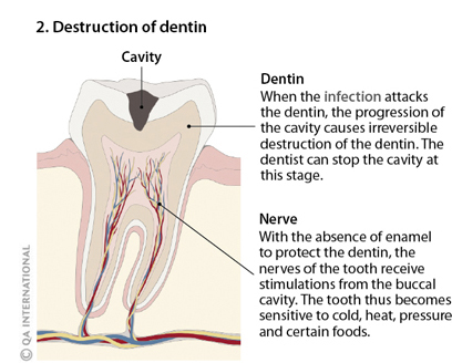 Destruction of dentine