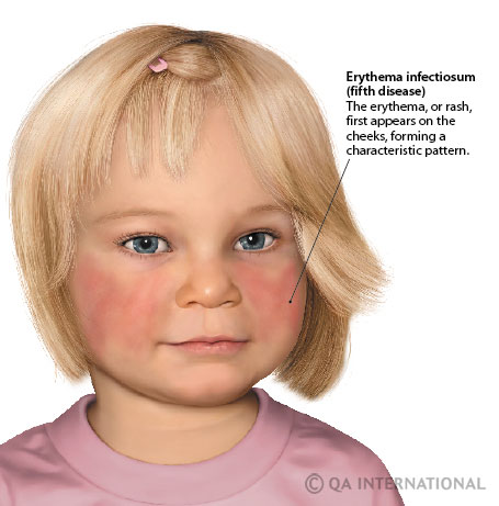 Babies and heat rashes: MedlinePlus Medical Encyclopedia