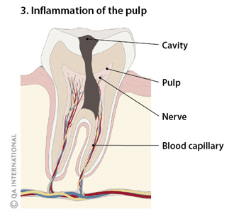 Inflammation of the pulp