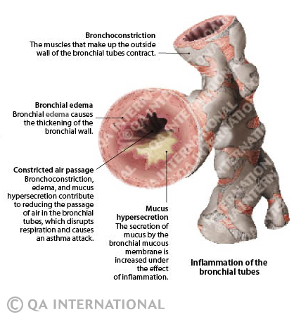 inflammation