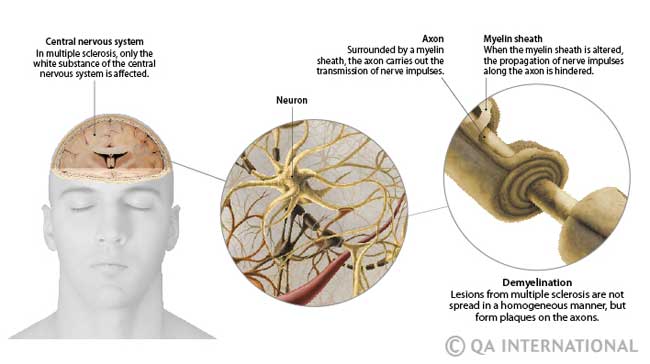 Multiple sclerosis