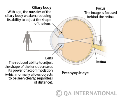 presbiopia és myopia)