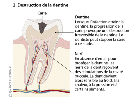 Destruction-dentine.jpg