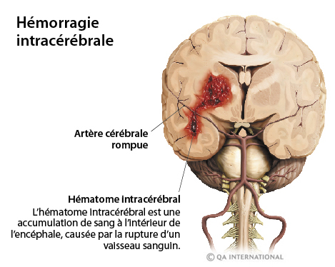 L’hémorragie cérébrale