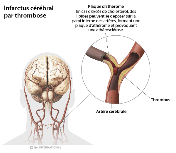 Infarctus cérébral thrombose