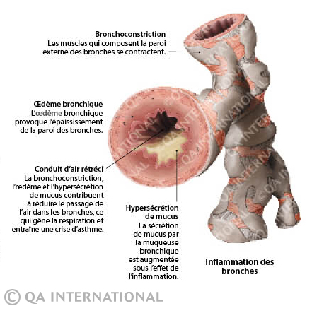 Inflammation bronche