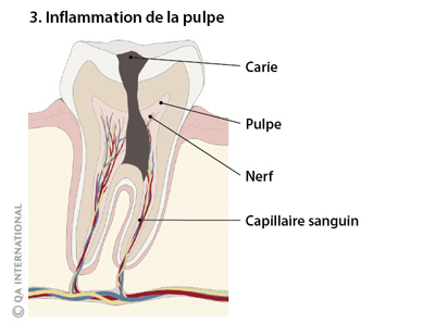 Inflammation de la pulpe