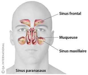 Schéma sinusite