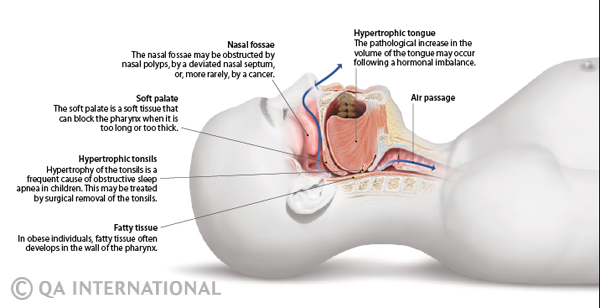 Obstructive sleep apnea