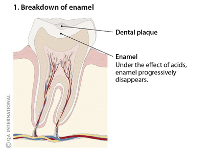 Breakdown of enamel