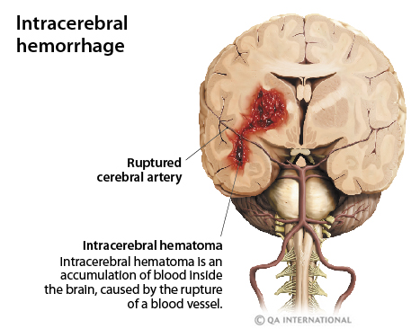 Cerebral hemorrhage