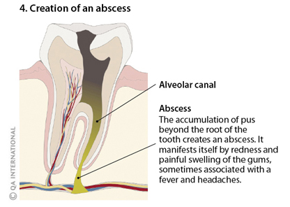 Creation of an abcess
