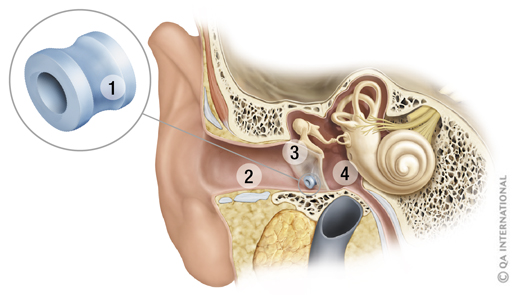 Ear schema