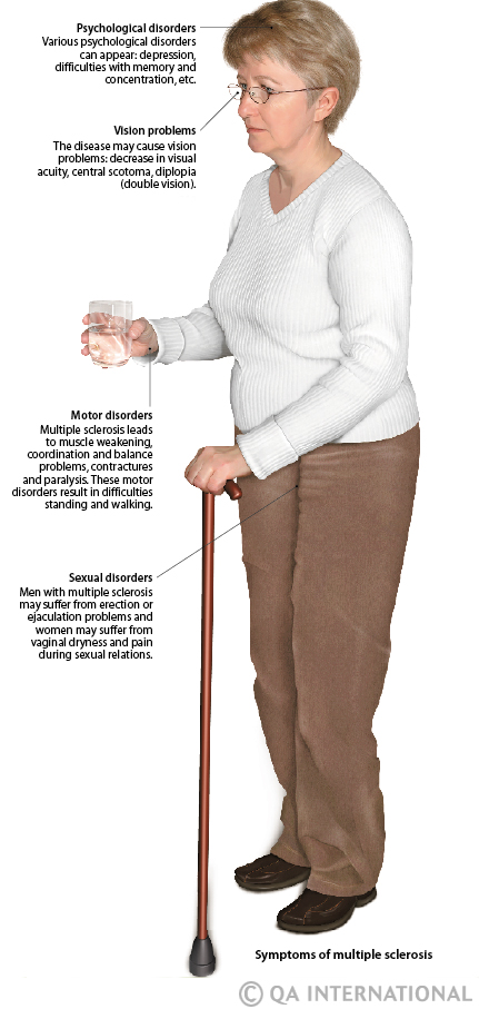 Evolution of multiple sclerosis