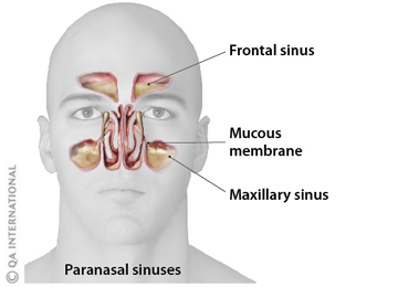 Sinusitis