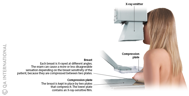 Mammogram