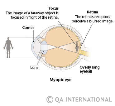 Myopia