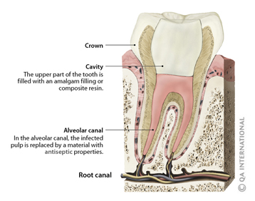 Root canal