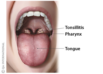 Tonsillitis