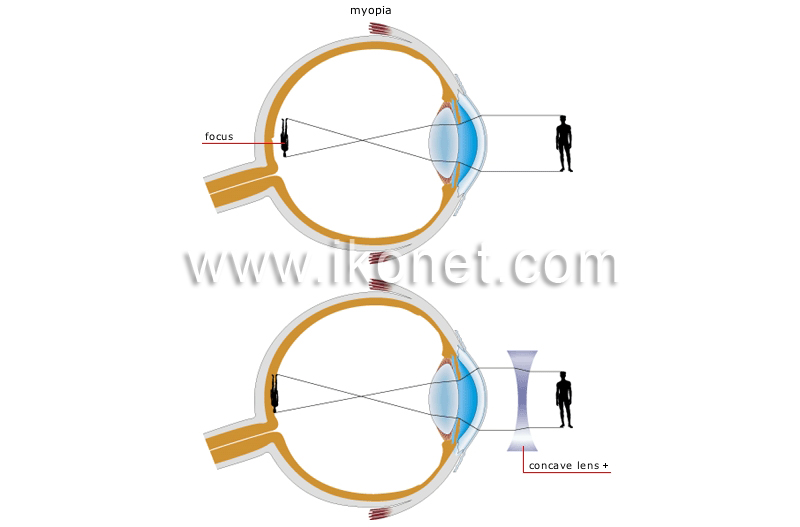 vision defects image