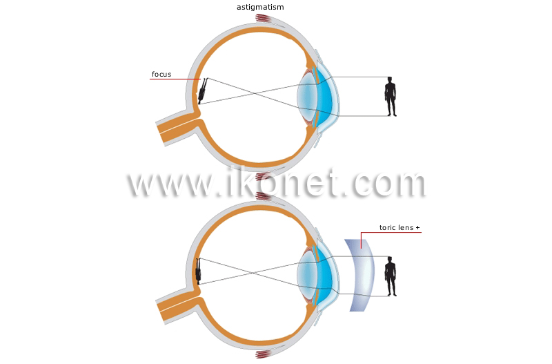 vision defects image