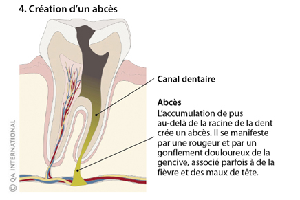 Création d'un abcès