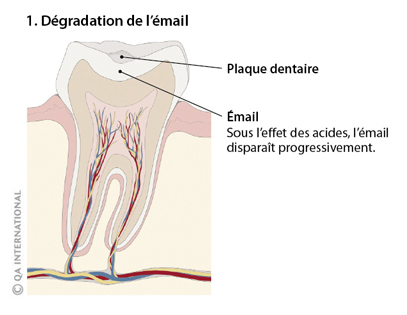 Dégradation de l'émail