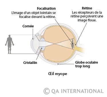 La myopie