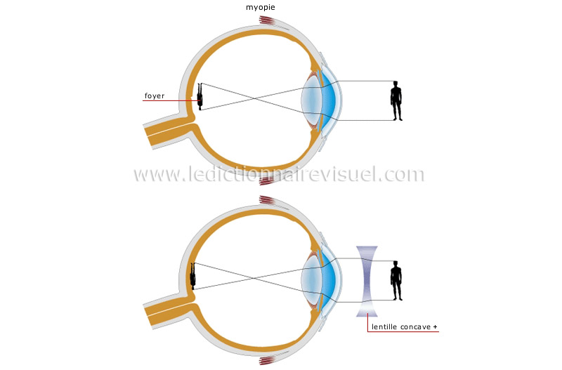 défauts de la vision image