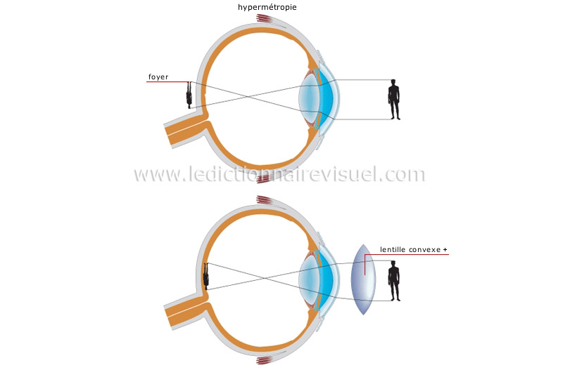 défauts de la vision image