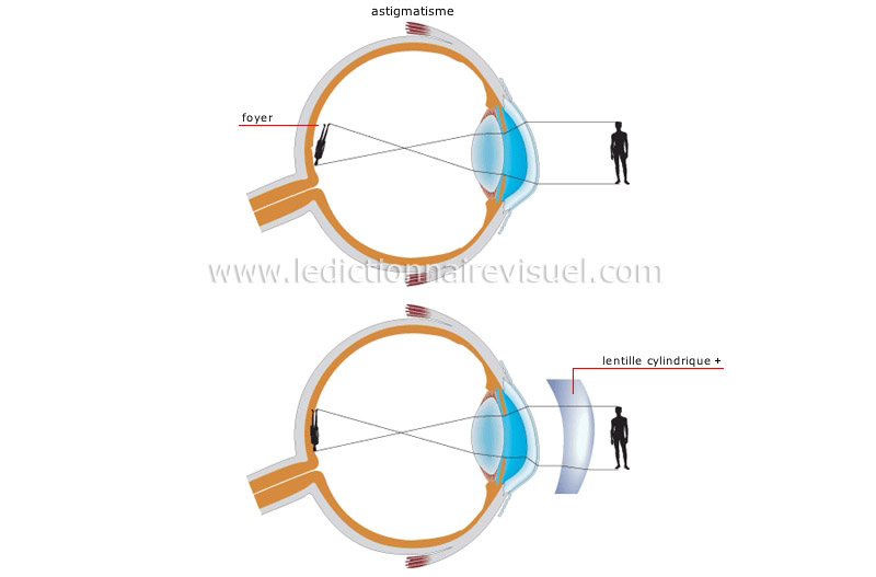 défauts de la vision image