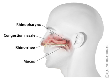 Les infections respiratoires | Dictionnaire Visuel