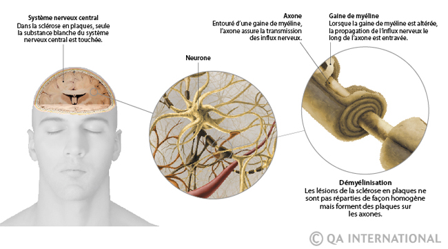 La sclérose en plaques